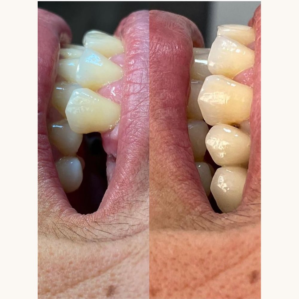Caso antes e depois — AK Odontologia