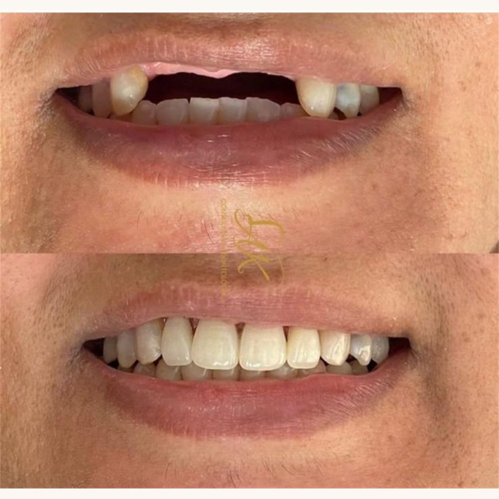 Caso antes e depois — AK Odontologia