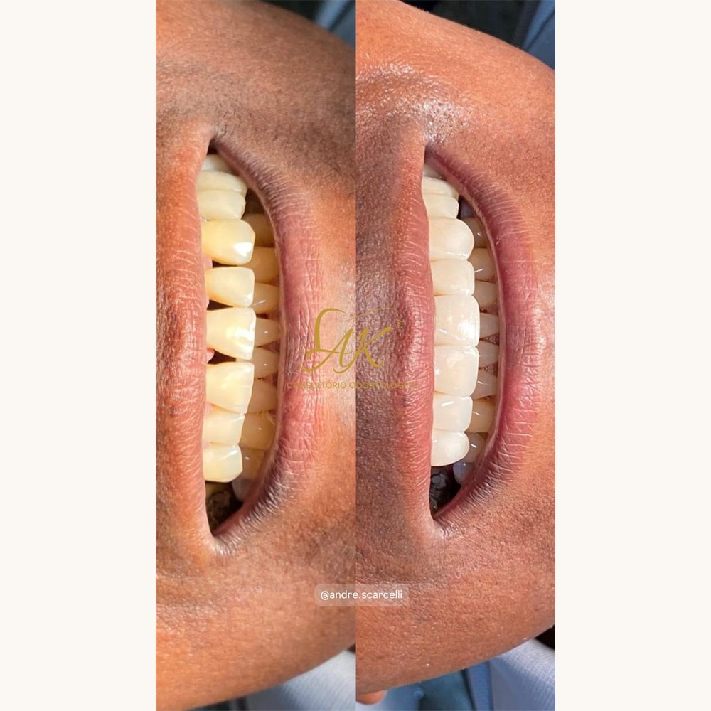 Caso antes e depois — AK Odontologia