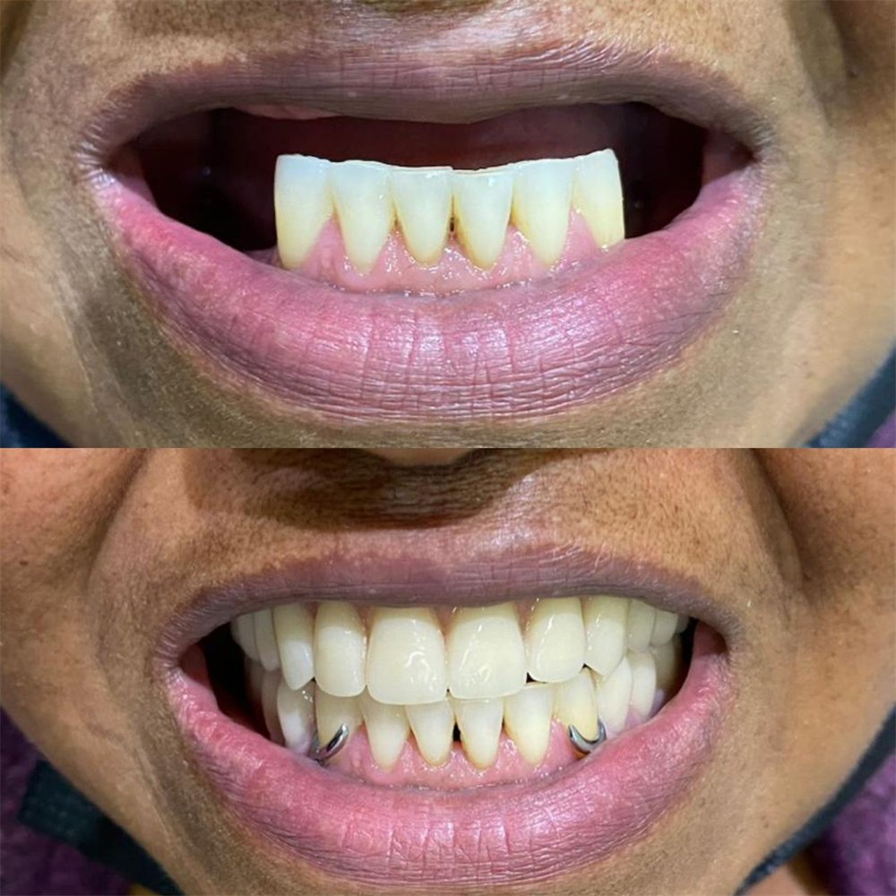 Caso antes e depois — AK Odontologia