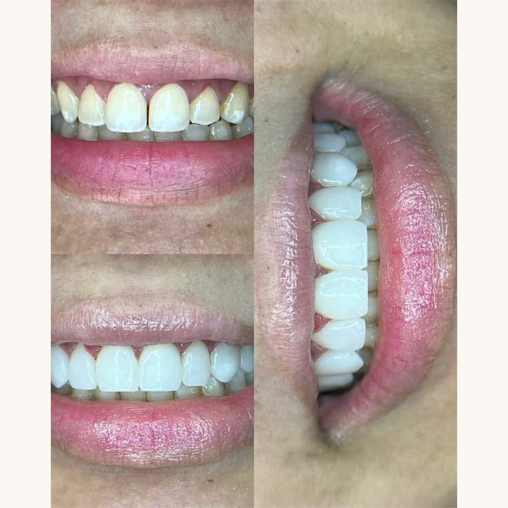 Caso antes e depois — AK Odontologia