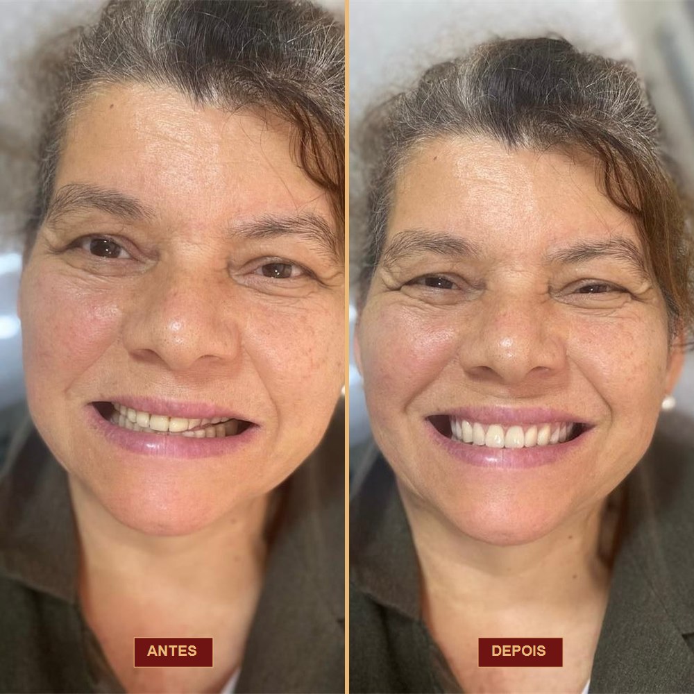 Caso antes e depois — AK Odontologia