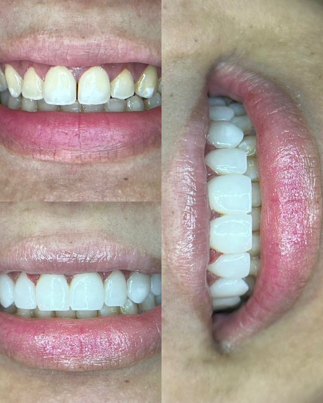 Caso de antes e depois — AK Odontologia