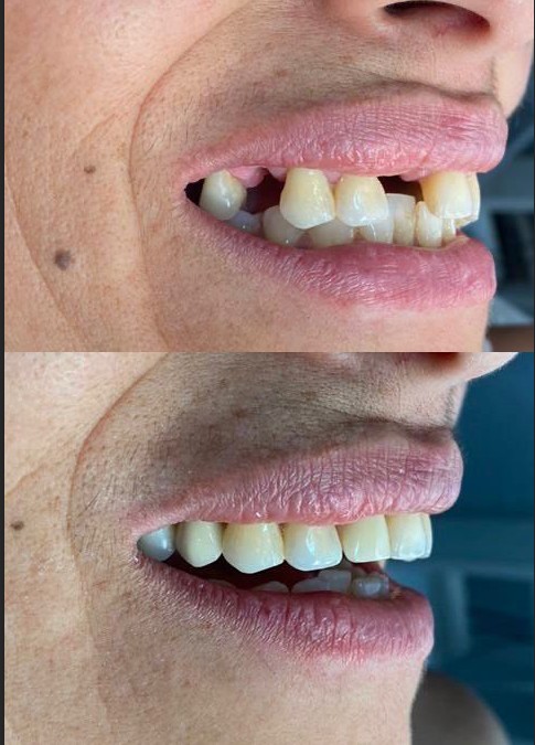 Caso de antes e depois — AK Odontologia